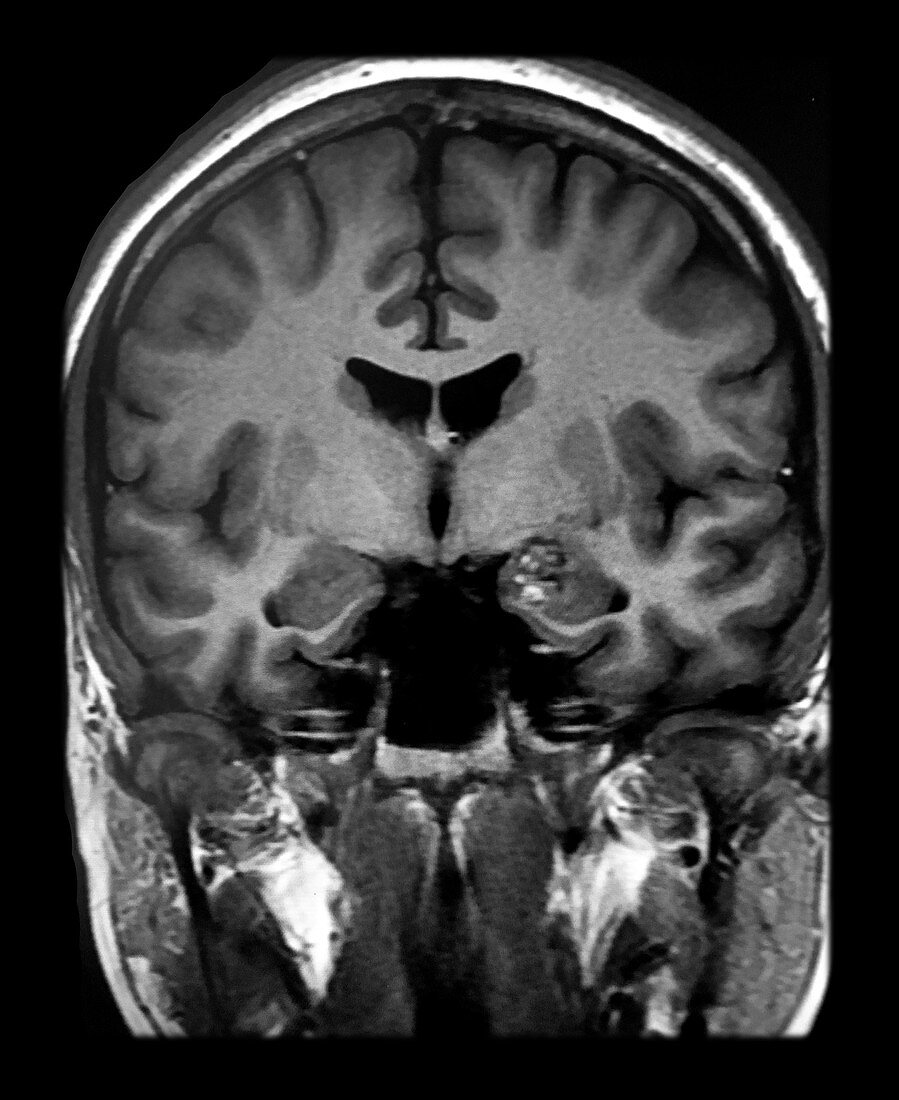 Temporal Lobe Cavernous Malformation MRI