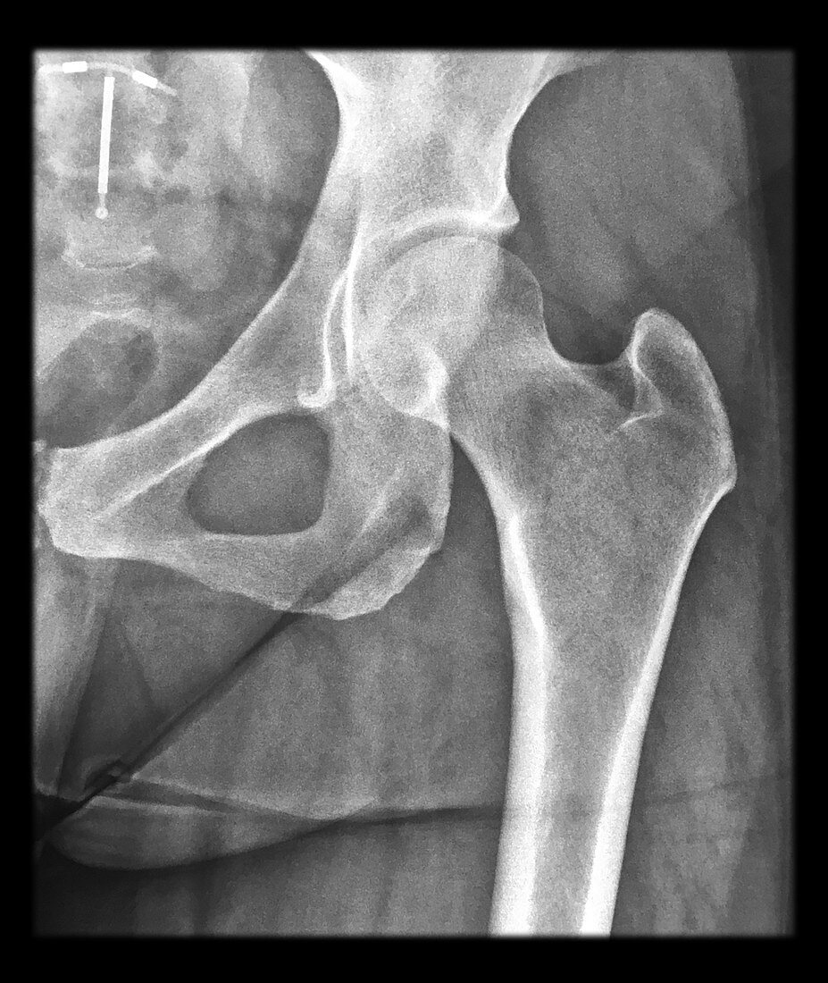Normal X-ray of Hip