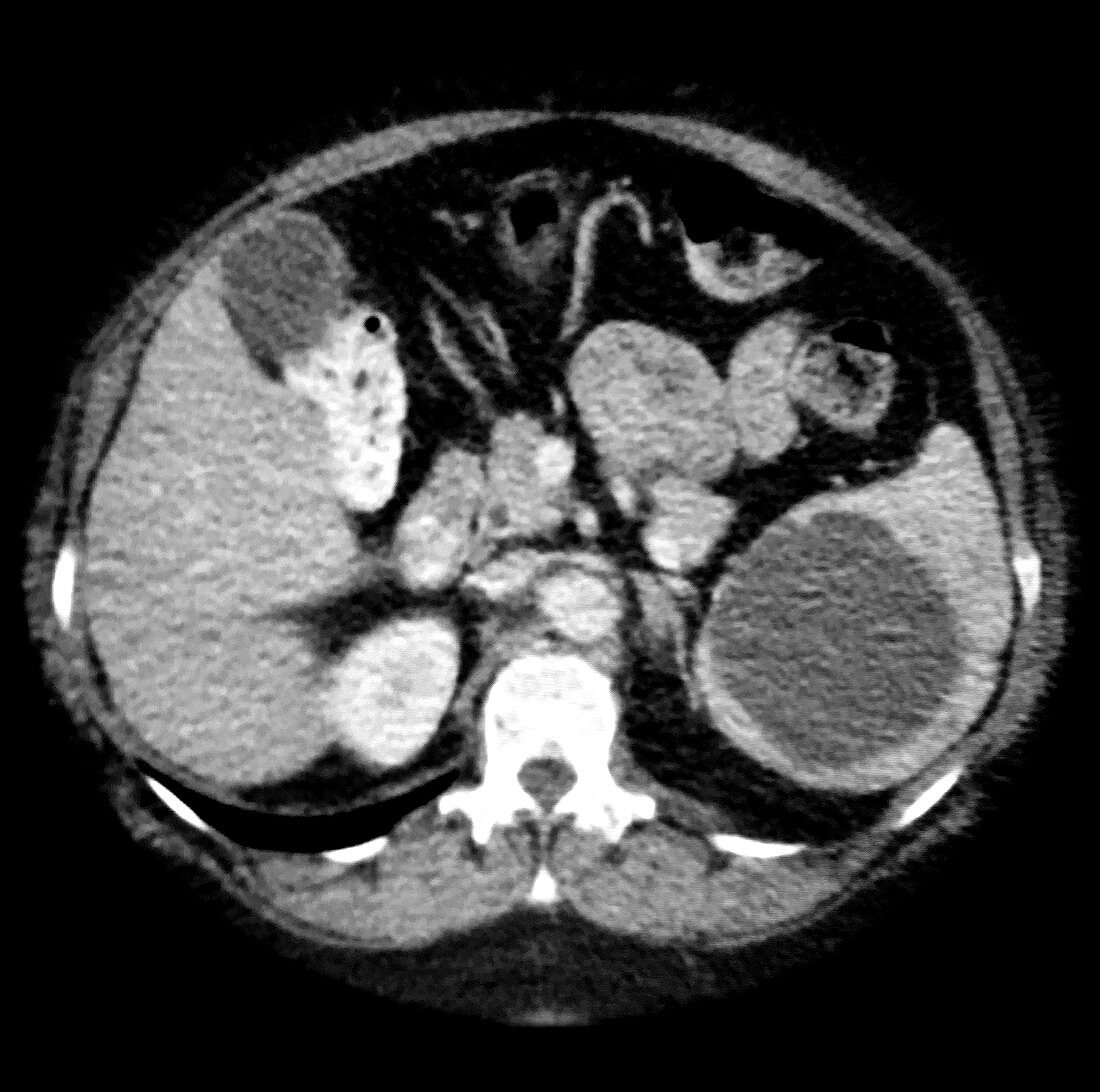 CT of Splenic Cyst