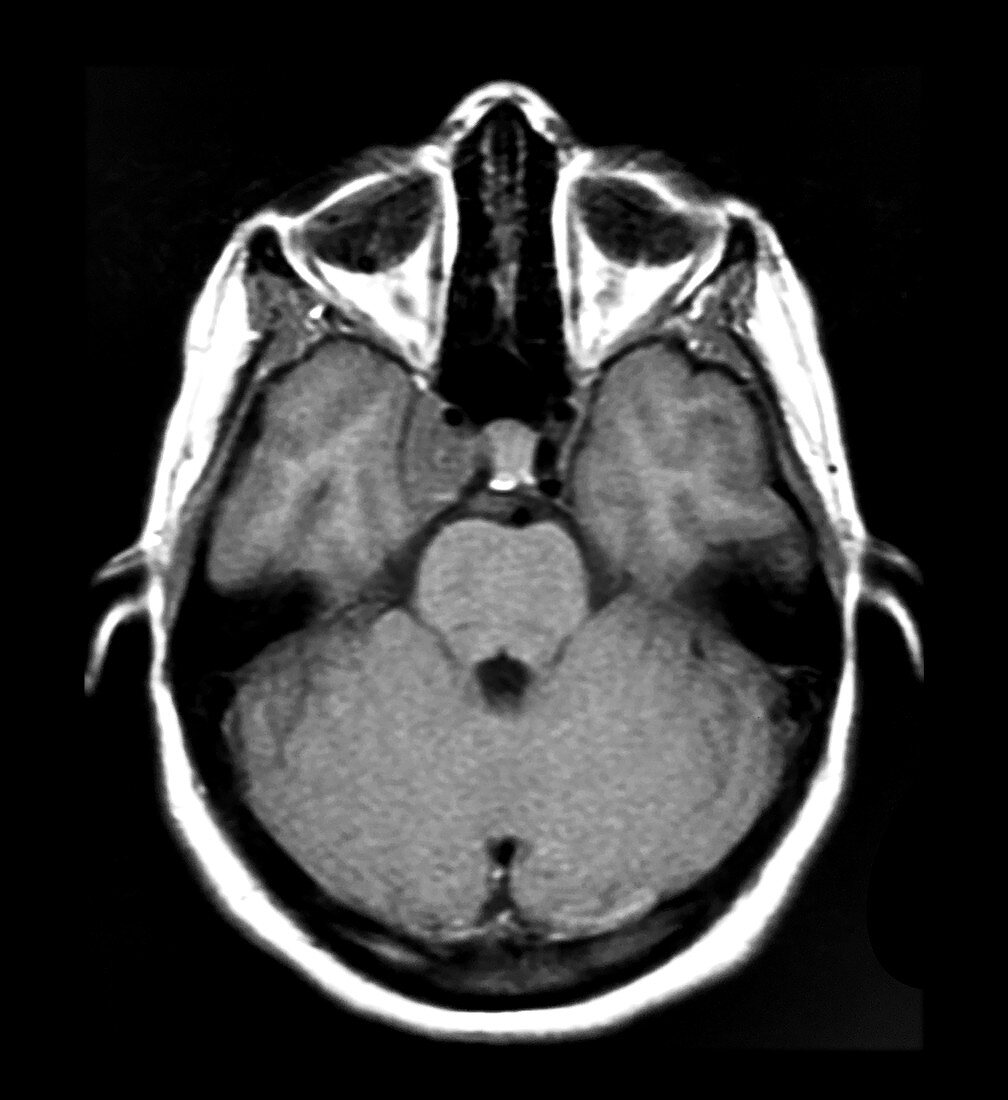 Lymphoma Cavernous Sinus MRI