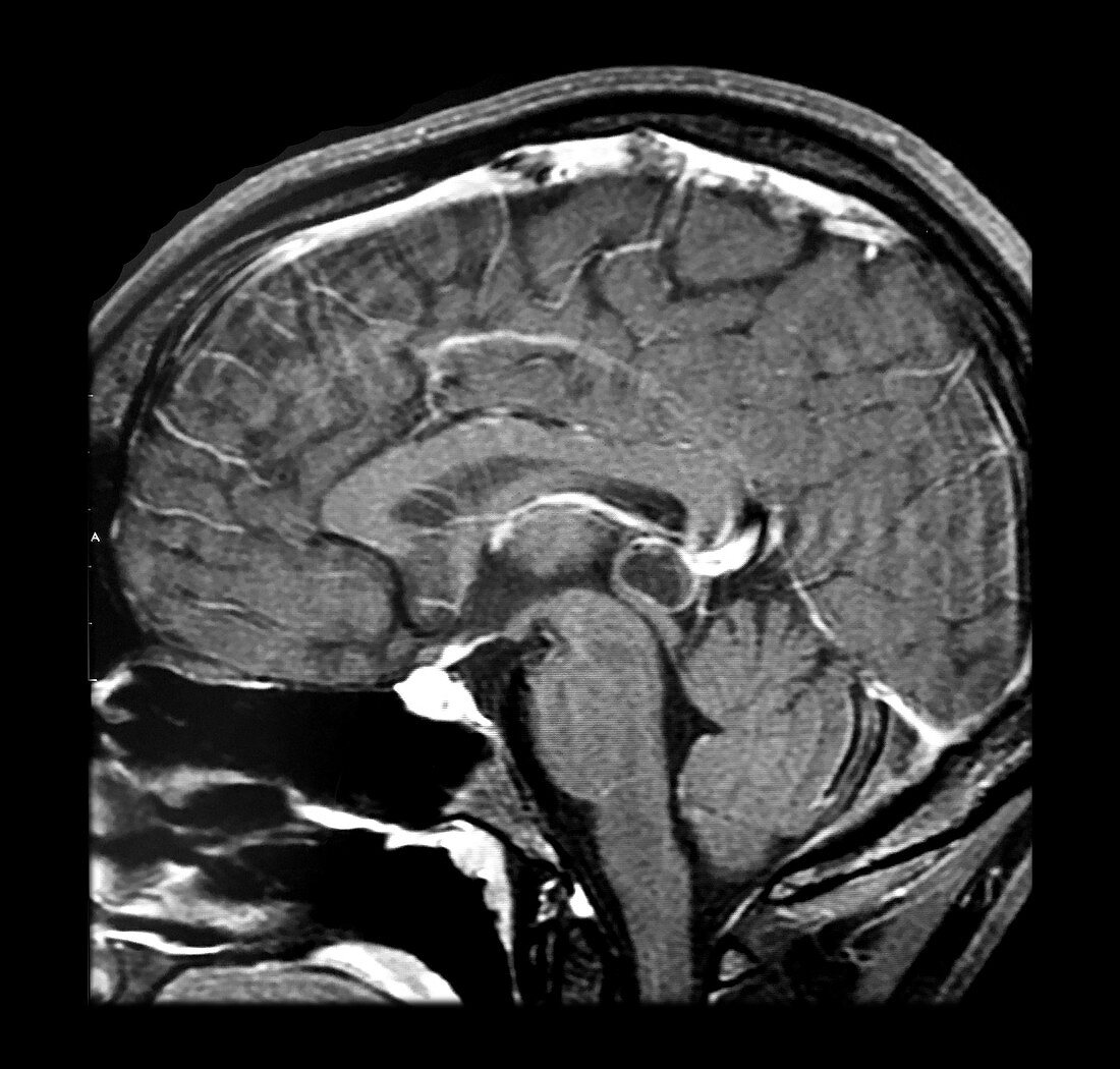 MRI Benign Pineal Cyst
