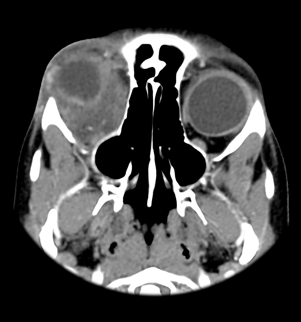 Orbital Pseudotumor on CT