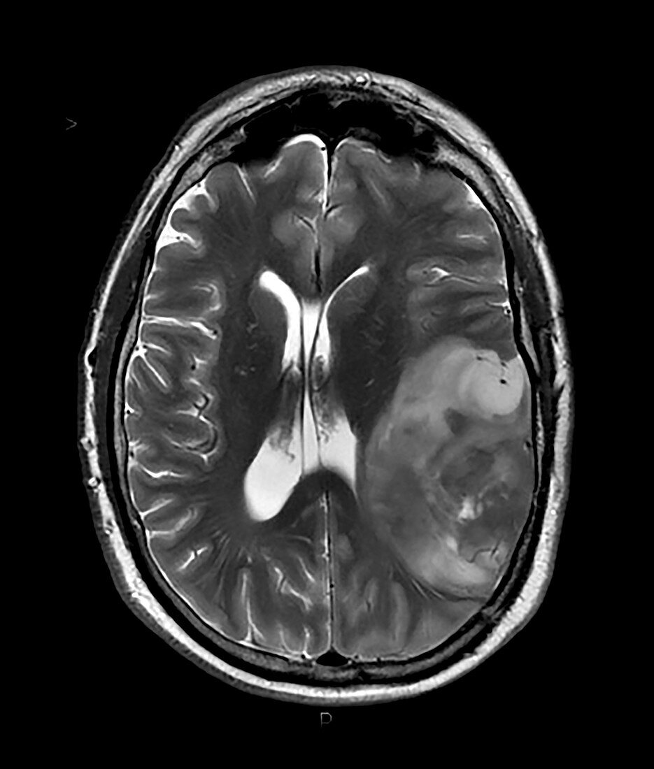 Ganglioglioma Brain Tumour MRI