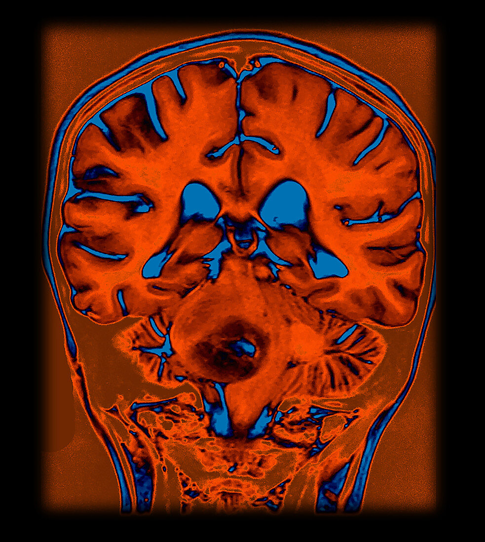 Enhanced MRI Brainstem Glioma