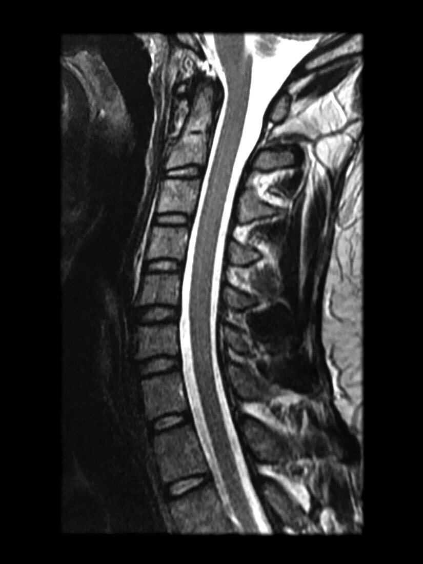 Normal MRI Cervical Spine