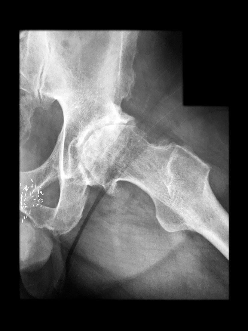 Severe Arthritis of Hip