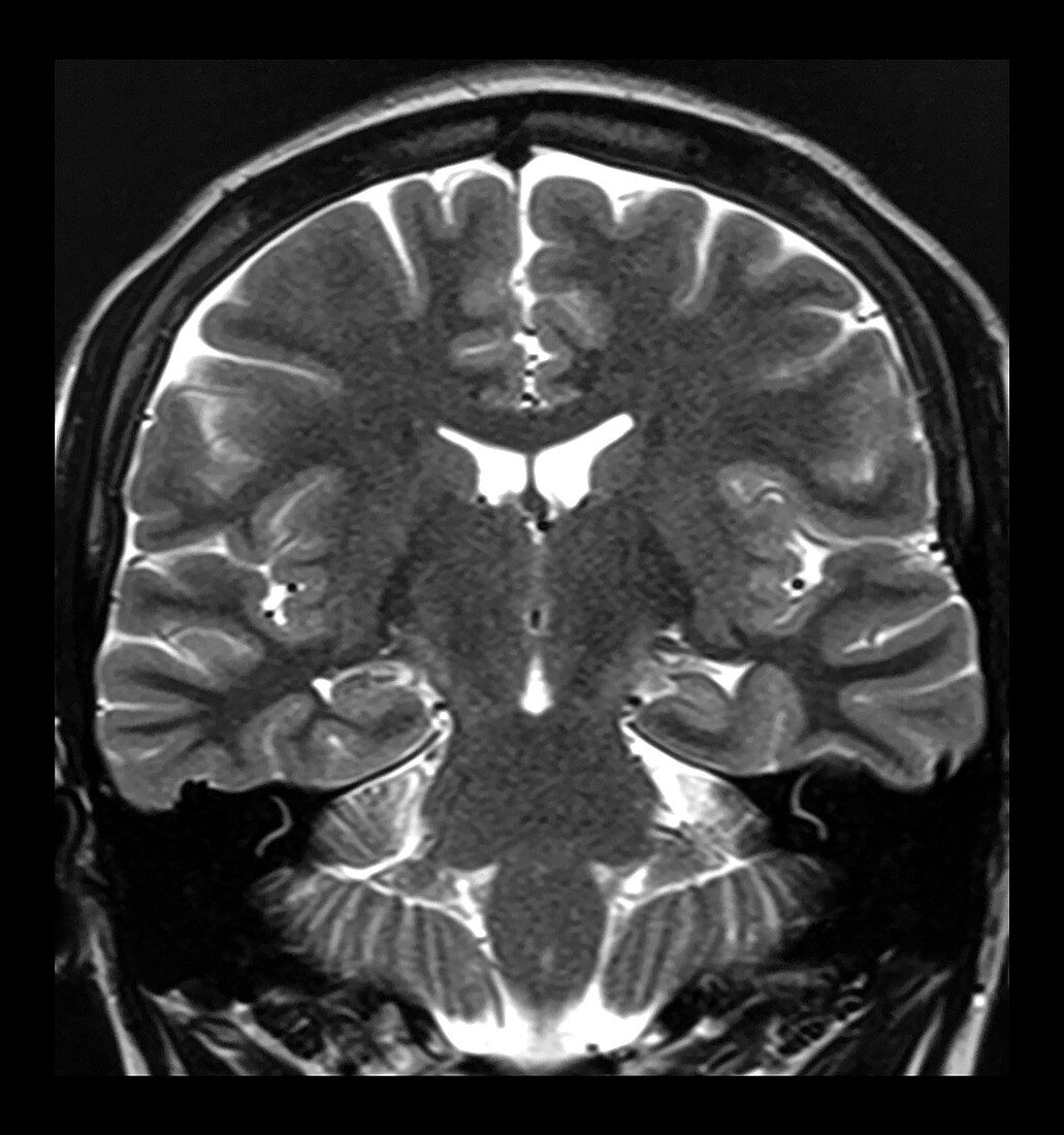 MRI Incomplete Inversion of Hippocampus
