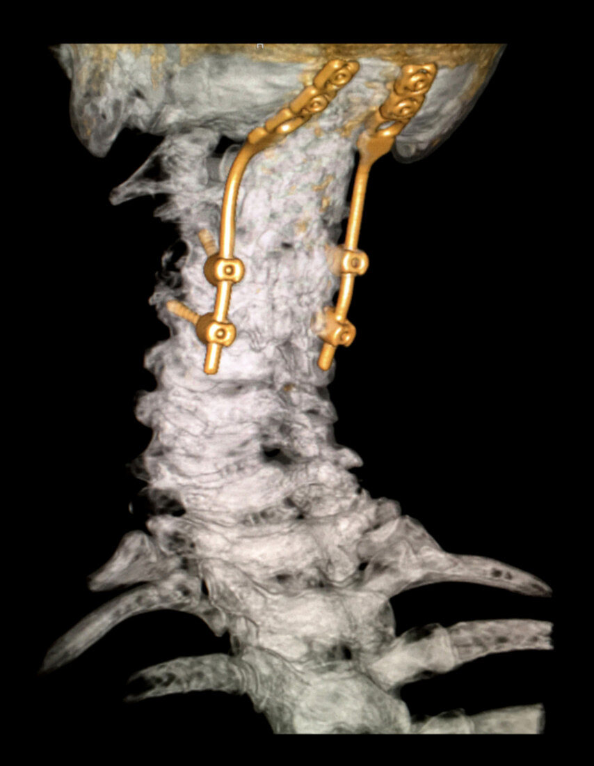 Occipital Cervical Fusion 3D CT