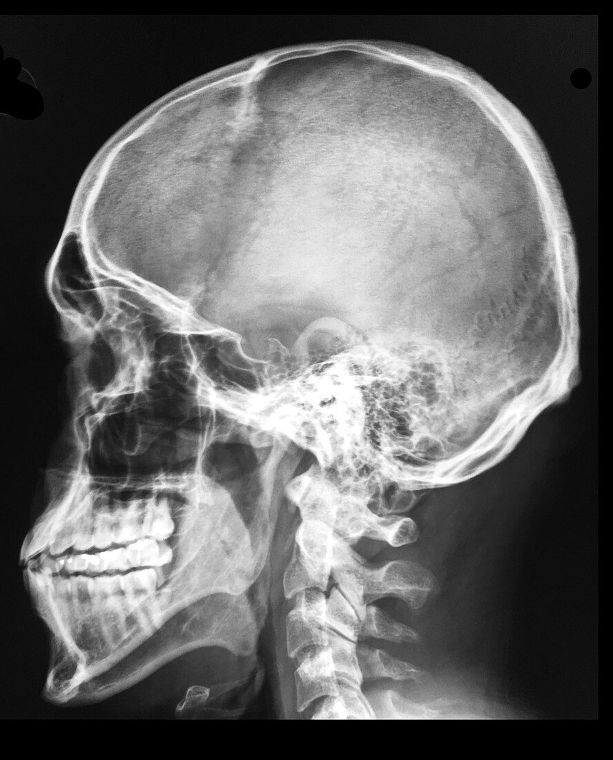 Lateral X-ray of Skull