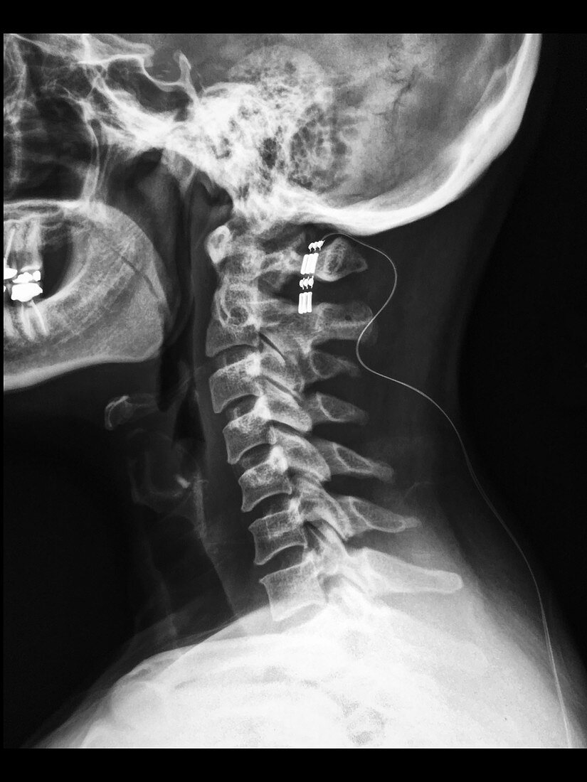 X-ray of Spinal Cord Stimulator