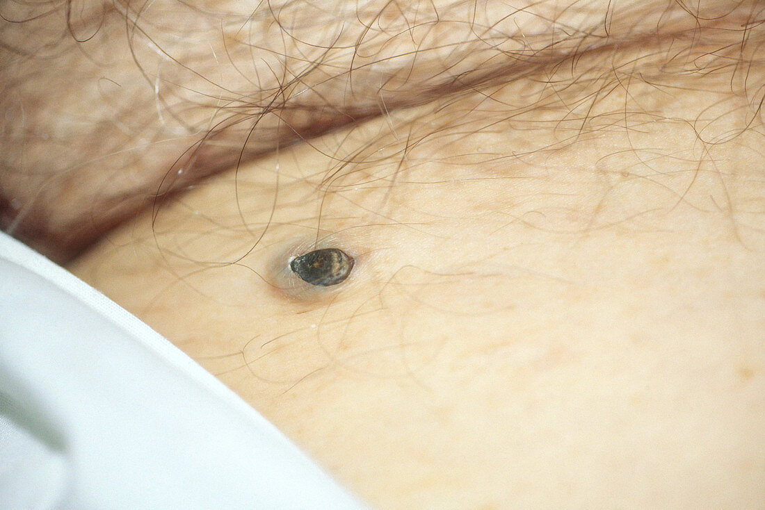 Dilated Pore of Winer