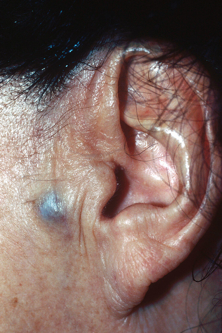 Blue Nevus