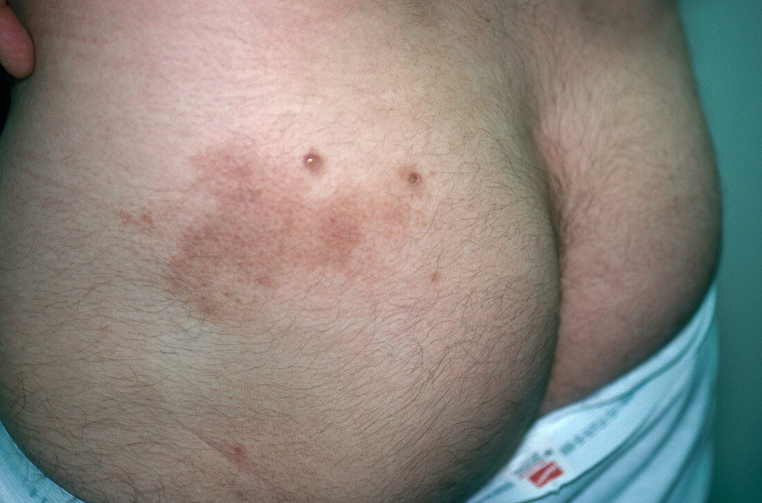 Mycosis Fungoides