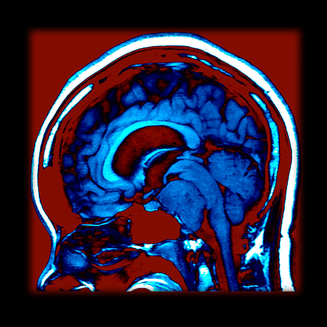 Enhanced Clival Meningioma on MRI