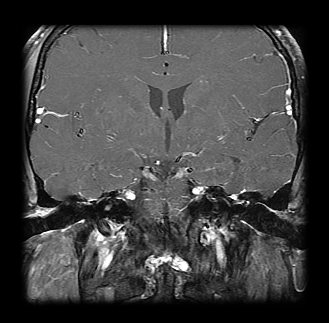 MRI Neurofibromatosis Type 2 (MISME) 4