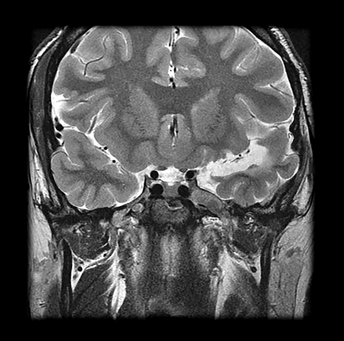 MRI Neurofibromatosis Type 2 (MISME) 1