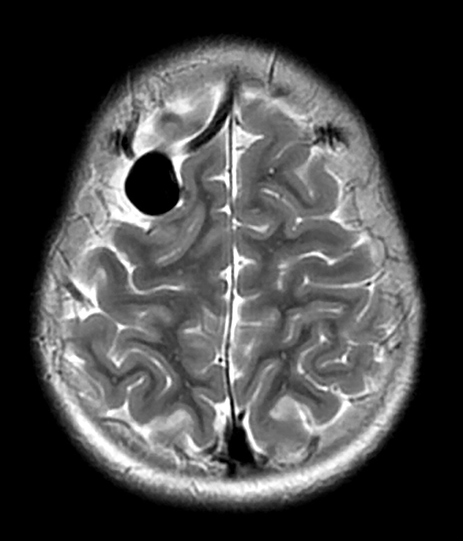MRI of Arterial Venous Fistulas 3