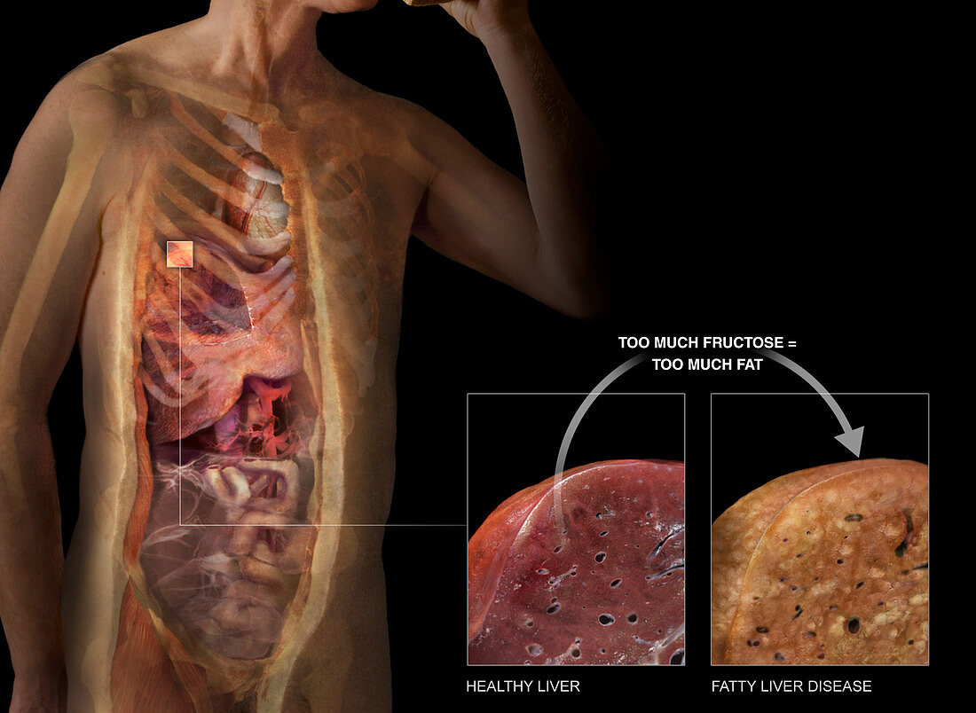 Sectioned Body and Liver, Fatty Liver Disease