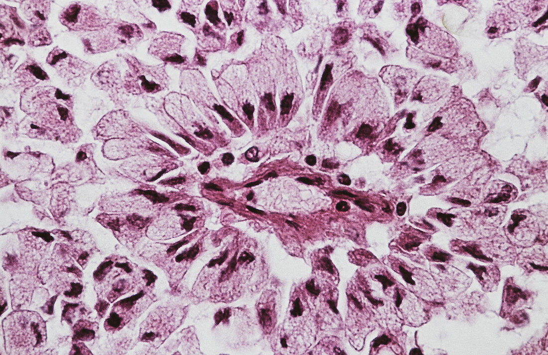 Pulmonary Alveolar cell cancer, LM