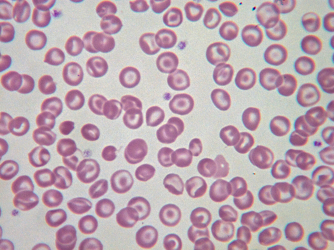 Target cells in anaemia, LM