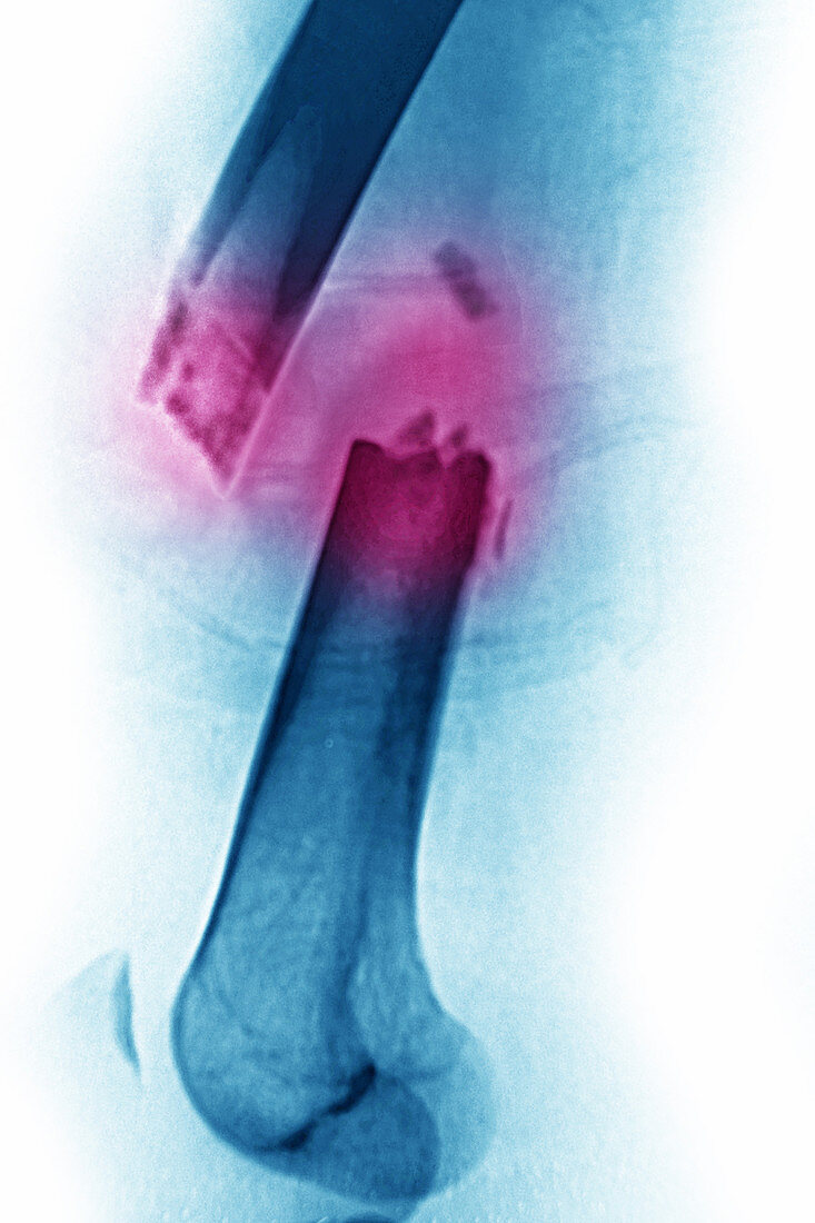 Femoral Fracture, X-ray