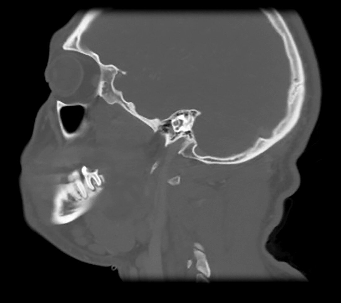 CT of Odontogenic Abscess Masticator Space