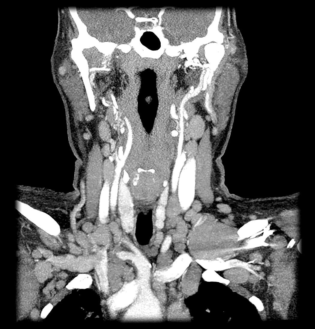 CT Neck in Lymphoma