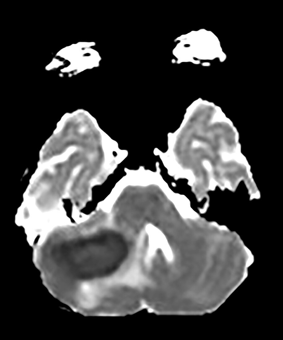 Cerebellar Abscess Secondary to Mastoiditis