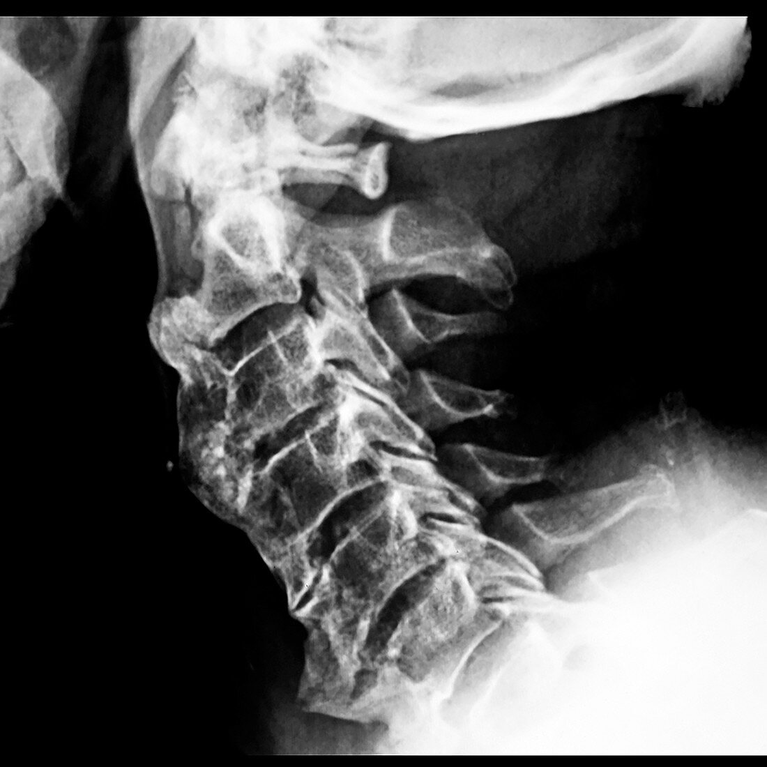 X-rays of DISH