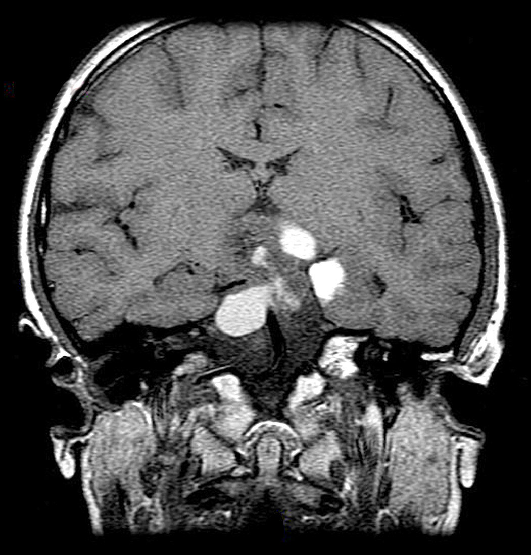 MRI of Craniopharyngioma