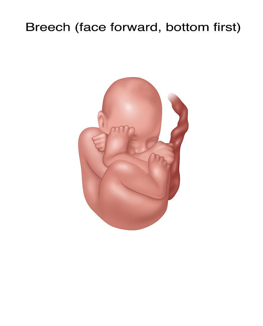 Fetus in Breech Position, Illustration