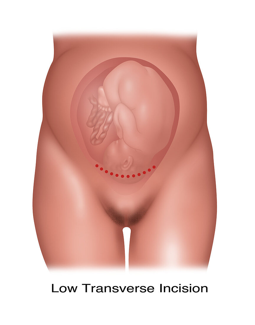 Low Transverse Caesarean Incision, Illustration