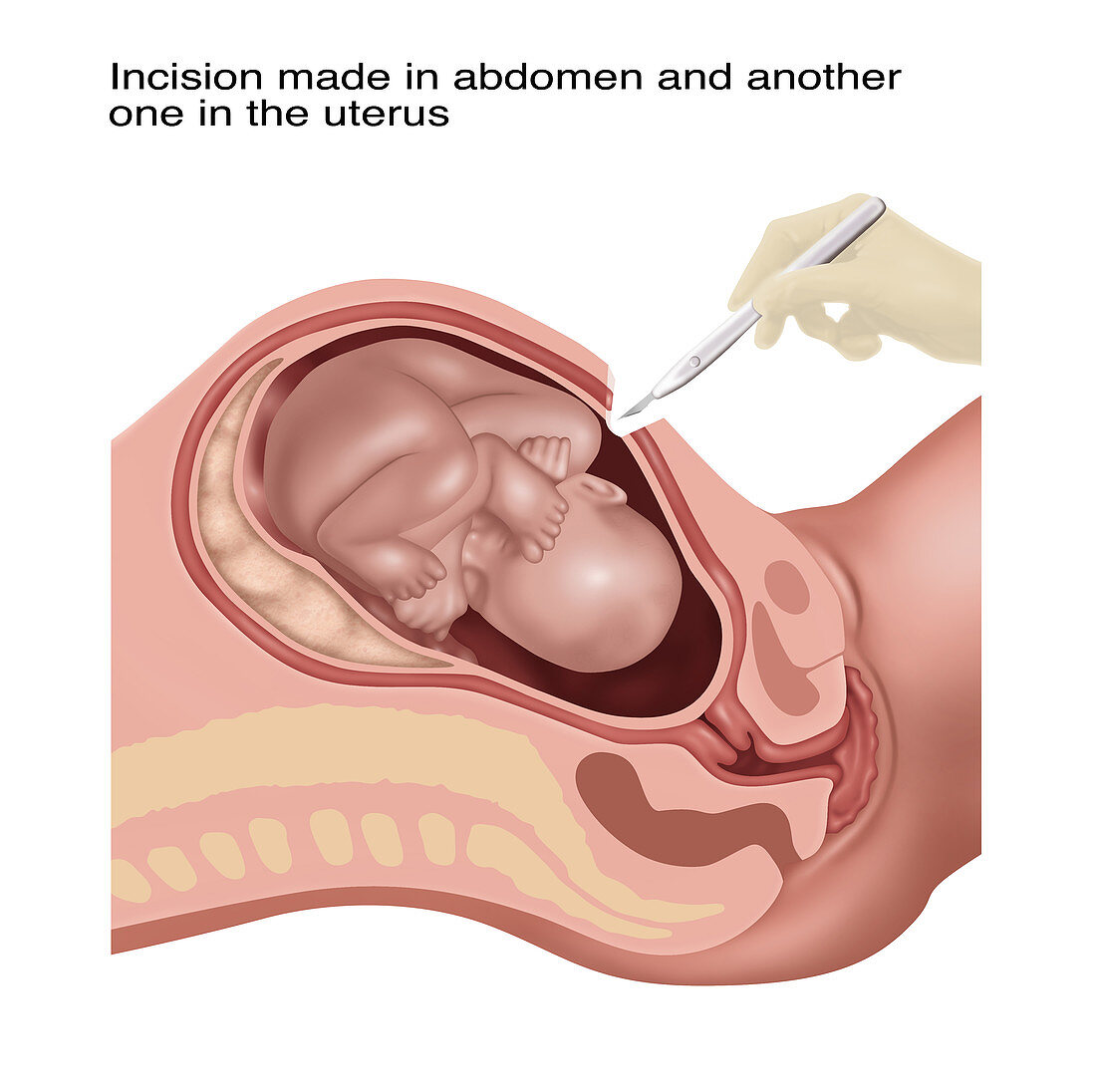Cesarean Section Steps, Illustration, 1 of 4