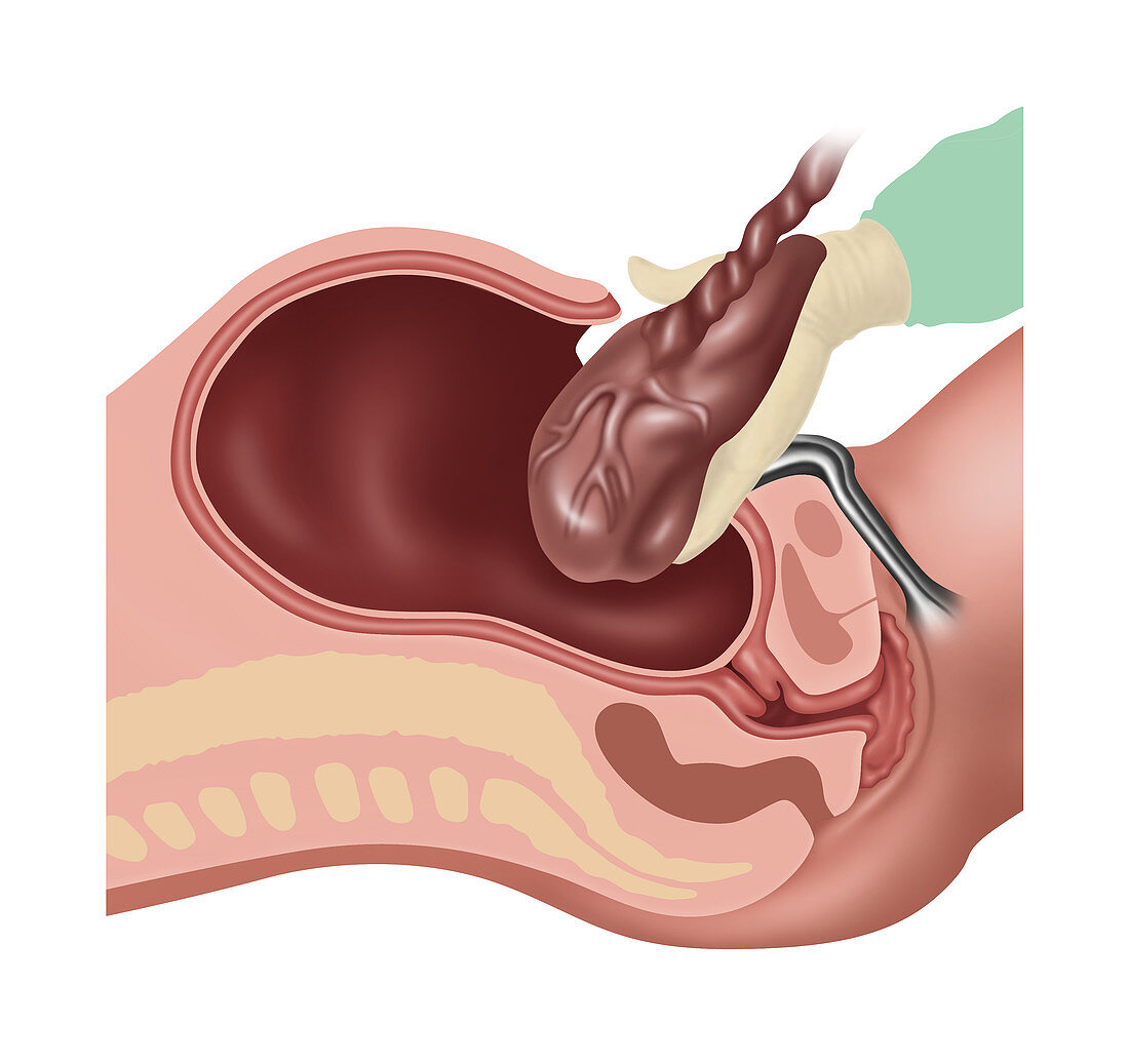 Cesarean Section Steps, Illustration, 3 of 4