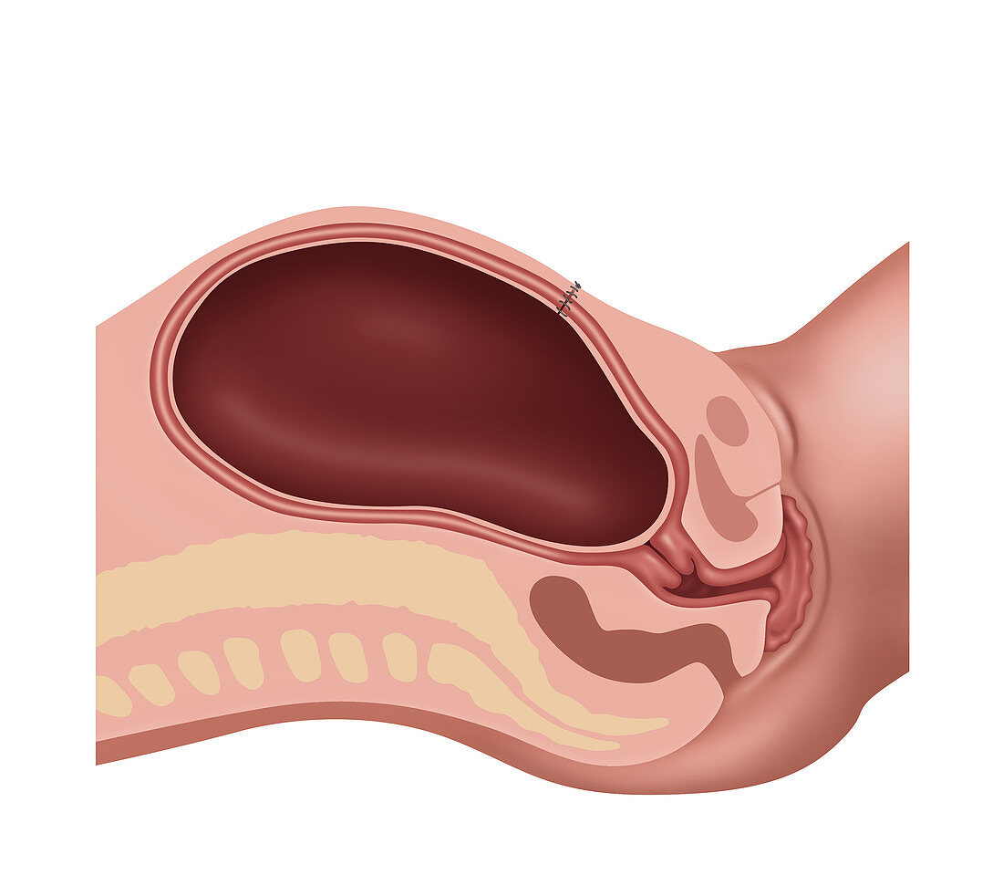Cesarean Section Steps, Illustration, 4 of 4