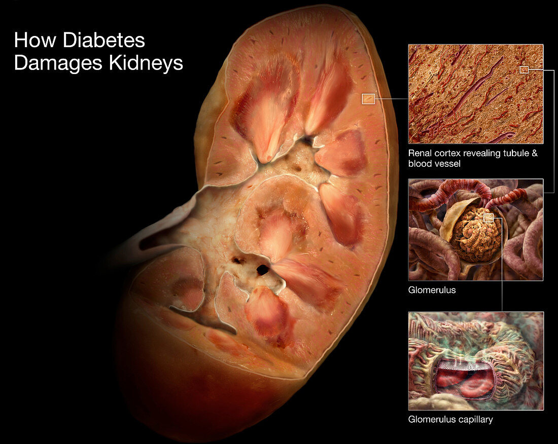 Diabetic Kidney Damage