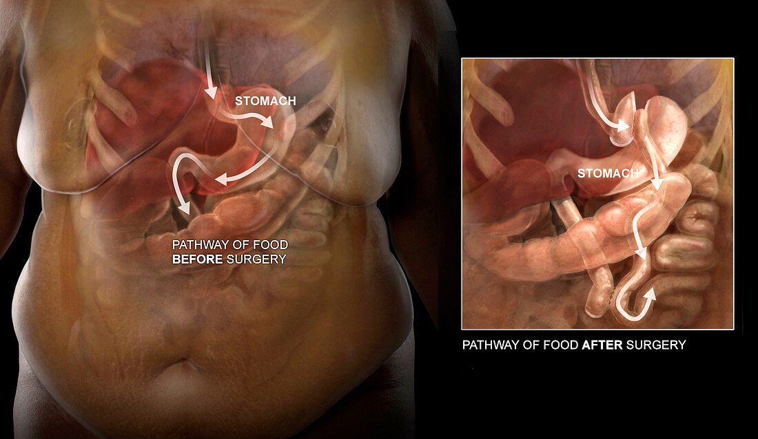 Bariatric Surgery, Before and After