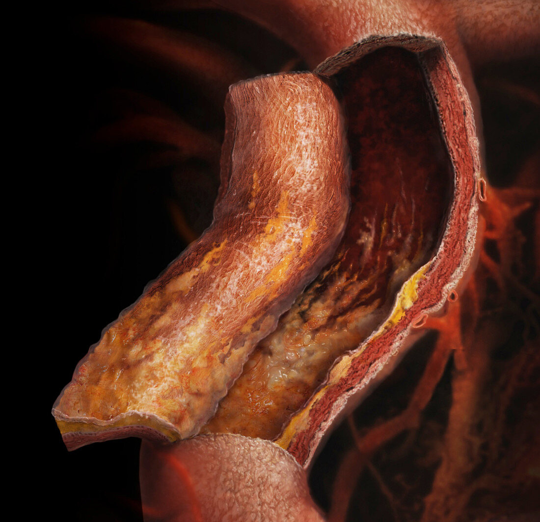 Plaque on Arteries