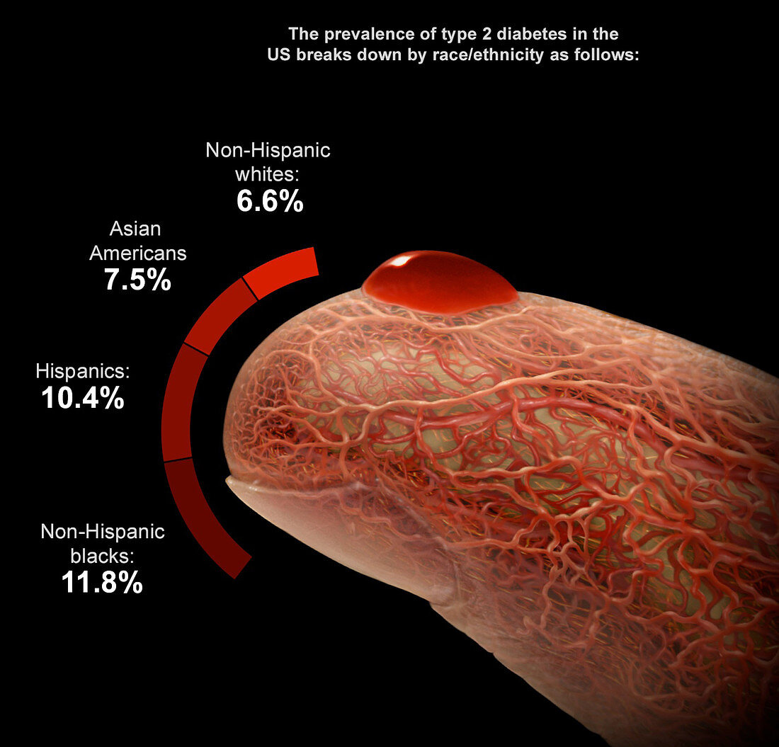 Type 2 Diabetes by Race and Ethnicity