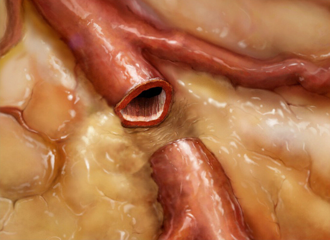 Sectioned Artery in Fat Tissue