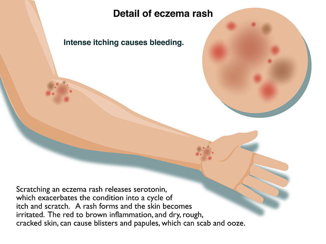 Eczema rash, infographic