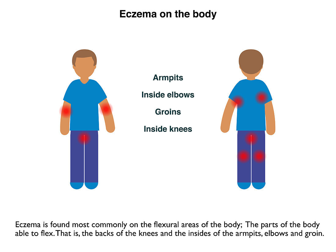 Areas of Eczema, infographic