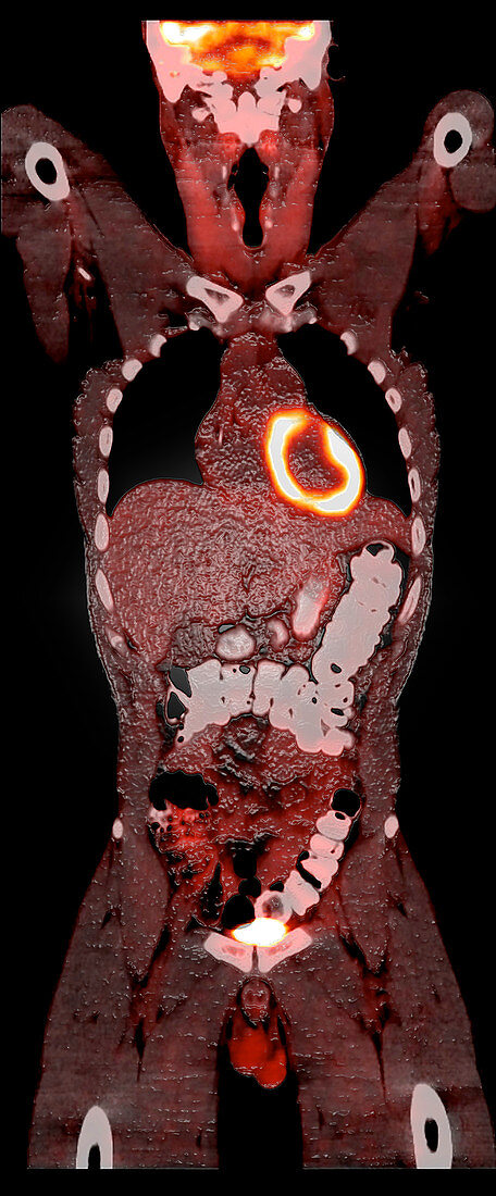 Normal PET CT Scan of Adult Male