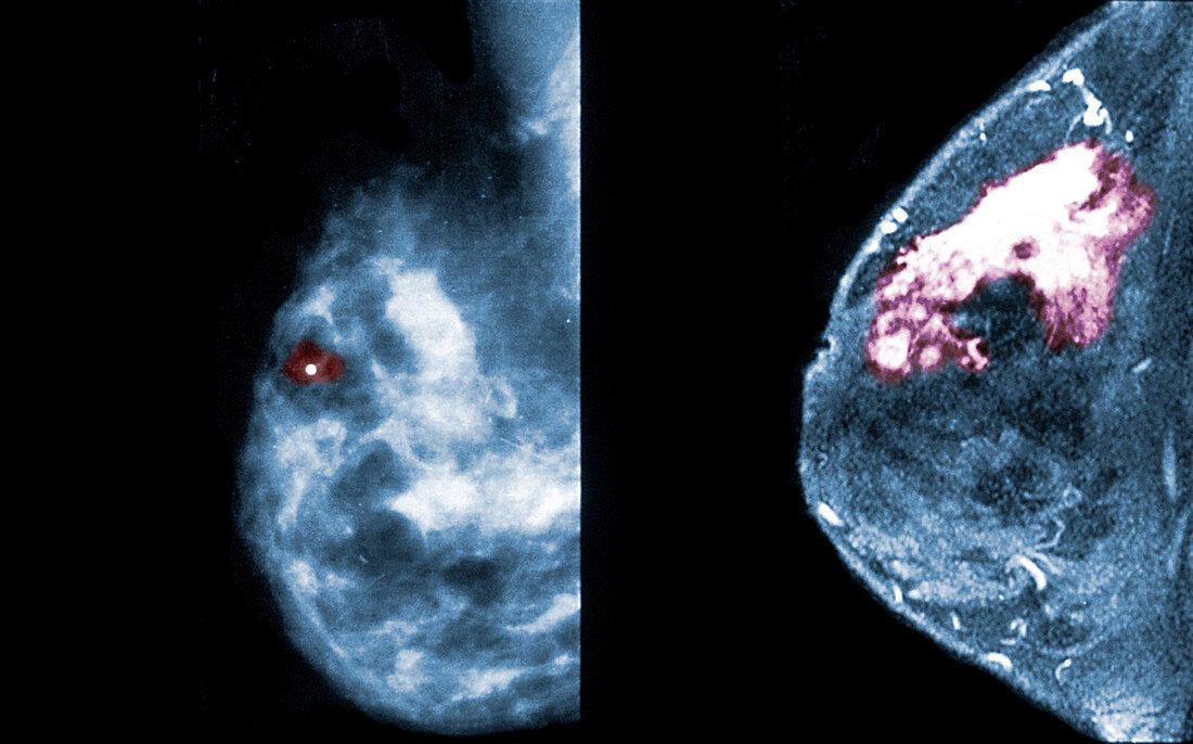 Breast Cancer, Mammogram vs. MRI