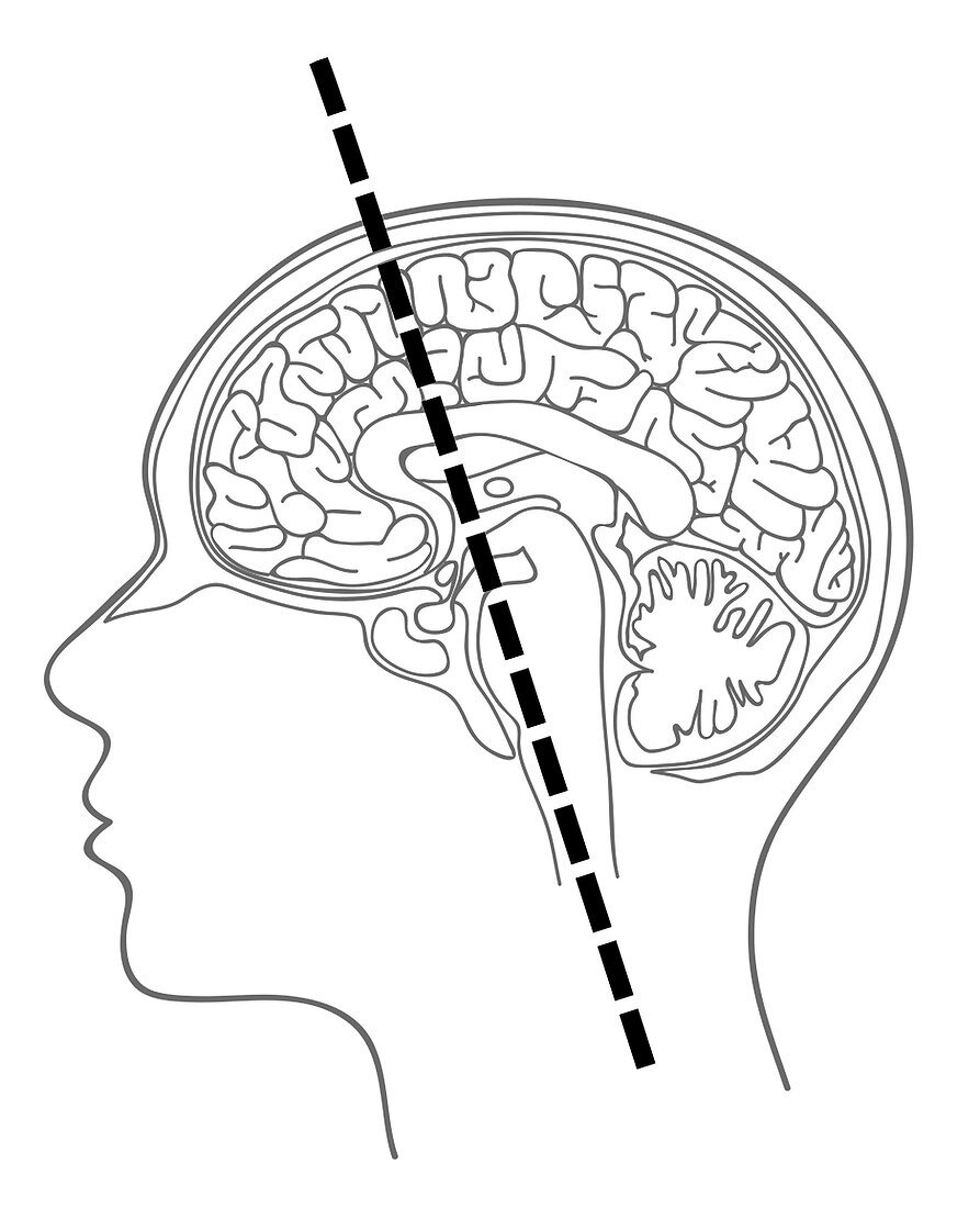 Brain Neuroaxis, Illustration