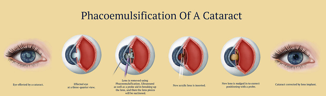 Cataract Surgery, Illustration
