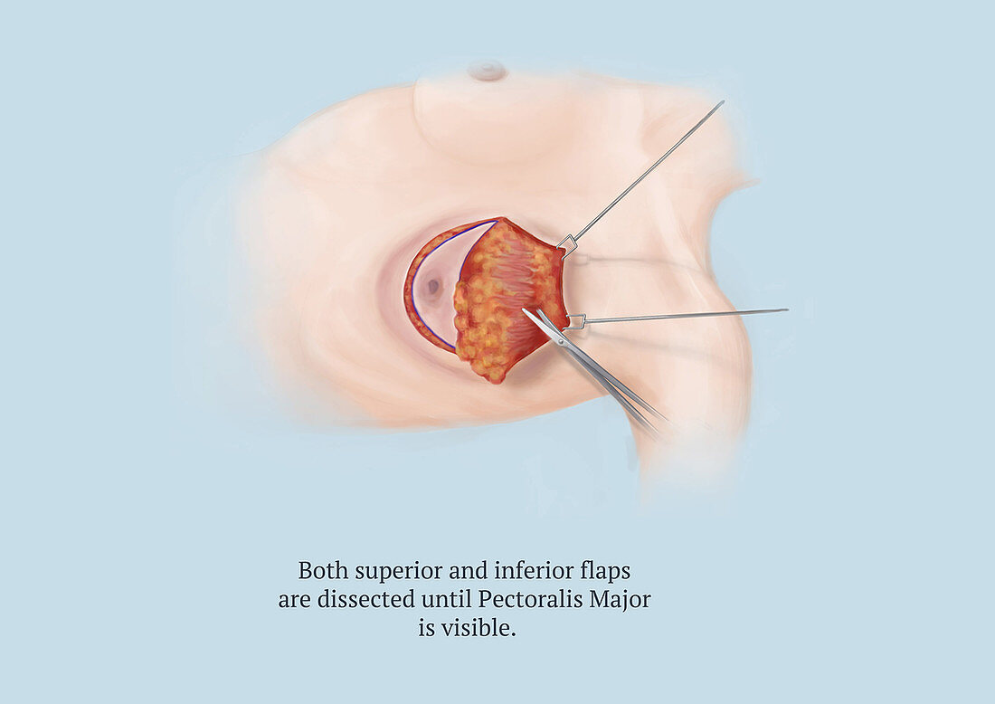 Mastectomy, Step 5 of 8, Illustration