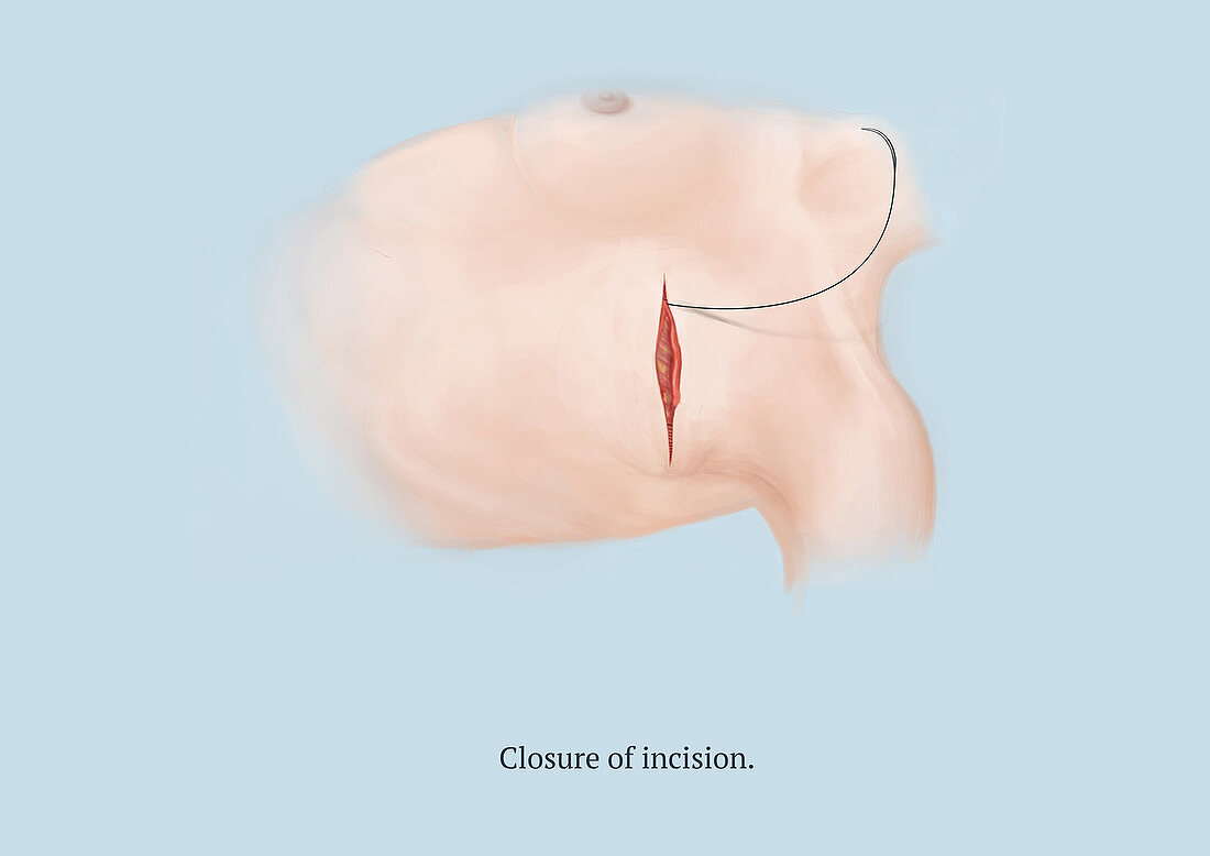 Mastectomy, Step 7 of 8, Illustration