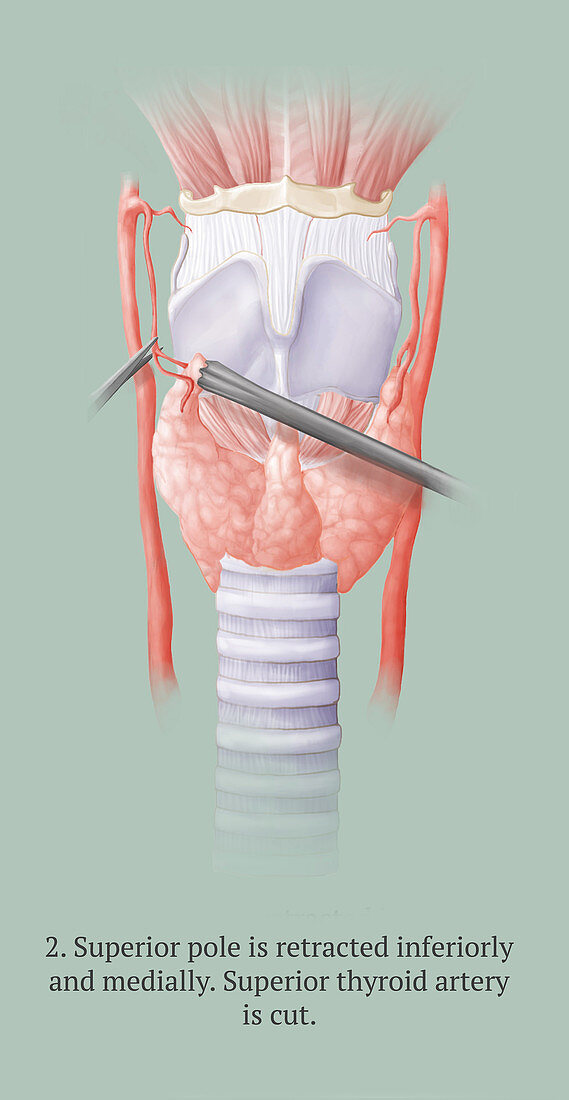 Thyroidectomy, 2 of 5
