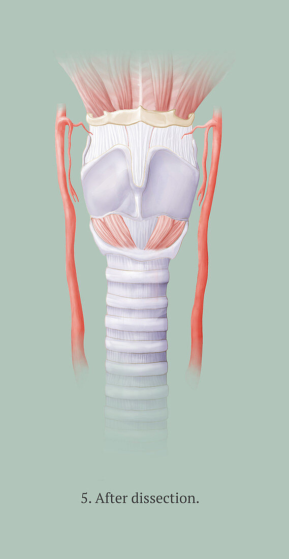 Thyroidectomy, 5 of 5